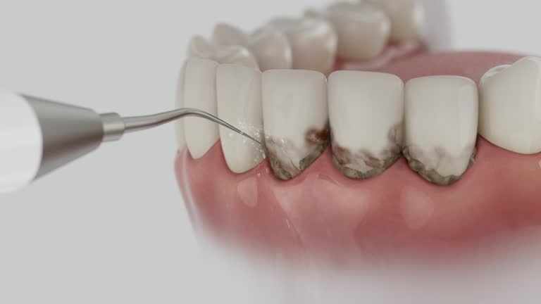 Trusted Dental Crowns And Bridges service in Burbank, CA - Dentist Open Now